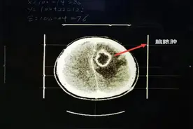 挤痘痘竟致脑脓肿，手术抽出脓液10多毫升！医生：面部危险三角区碰不得图片