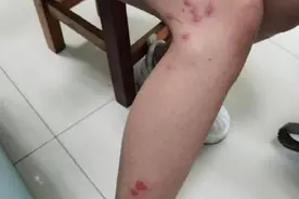 女子长了一腿包竟与撸猫有关图片