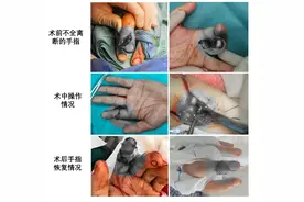 【朝医新闻】骨病中心五部综合骨科为手指离断患者成功实施断指再植手术2例图片