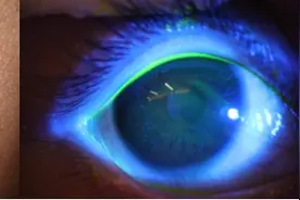 男孩使用暖宝宝炸伤眼睛 寒冬季节当心“取暖神器”给孩子带来危险图片