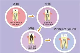 “晚上牙疼得要命！”关于急性牙髓炎，听听专家怎么说图片
