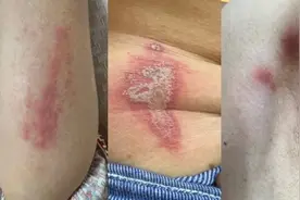 小心“飞行的硫酸”！医院半天接诊十余例，这种小飞虫不要用手拍打图片