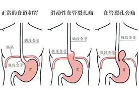反酸烧心就是“胃病”？不一定！很可能是食管裂孔疝作祟！图片
