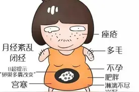 得了多囊卵巢综合症怎么办？松江医生提醒→丨健康智慧屋图片