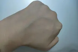 医生提醒：3处青筋异常凸起要留意！图片