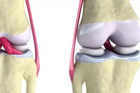 运动损伤高发季已至！肌肉拉伤？还是韧带拉伤？一文读懂！图片