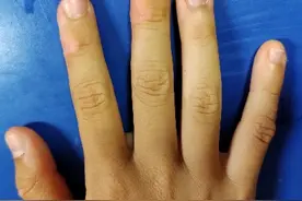 孩子把指甲都啃光了？妇儿医院专家：打骂是没有用的，教你这几招来纠正图片