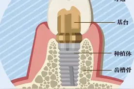 种好一颗牙的全流程，看完能安心种牙啦→图片