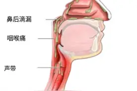 咳咳咳，白天不咳晚上咳，注意鼻后滴漏综合征!图片