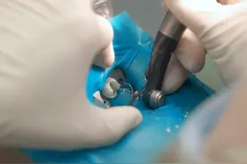 长沙市口腔医院根管治疗+医保省钱秘籍来啦！图片