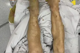 进入高发期！台州一男子被棕褐色的蛇咬一口，肿到青紫！看到请远离图片