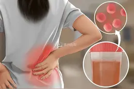 【朝医科普】尿色发红是咋回事儿？图片