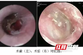 卓越医疗丨永州市中心医院：助力车祸致严重鼓膜穿孔患者恢复听力图片
