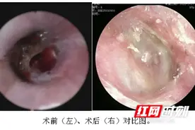 卓越医疗丨永州市中心医院：助力车祸致严重鼓膜穿孔患者恢复听力图片
