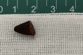 男子咳嗽两个月不愈竟是辣椒尖潜伏肺内，医生：反复咳嗽或是异物呛入图片