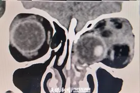 女子从3楼坠落眼球掉进鼻子！贵医附院紧急手术复位眼球保住视力图片
