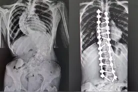 手术后，这个湖南女孩长高6厘米！经济困难脊柱畸形患者可申请救助图片