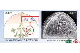 我的“副乳”怎么长到腋下了？图片