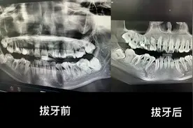 “女子拔牙后坠亡”？当地卫健委回应图片