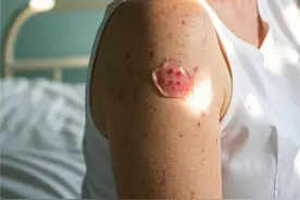 小心“蛇缠腰”上身！疼痛科医生教您无痛抗“蛇毒”图片