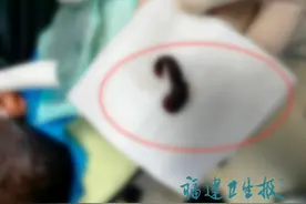 男子反复流鼻血，医生一查傻眼：取出一整条水蛭图片