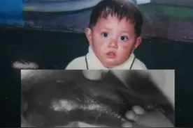 博主身患罕见病，皮肤一碰就破损，拍视频记录“蝴蝶宝贝”图片