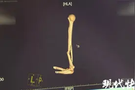 高中生和同学掰手腕，粉碎性骨折！图片