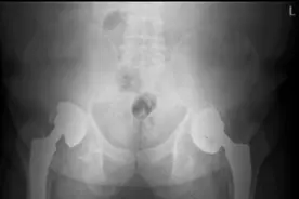 体重250斤，60岁大爷髋关节不忍重负！青岛市第八人民医院骨一科挑战极限完成高难度手术图片