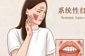 冲上热搜！红斑狼疮到底是什么病，患上有多严重？图片