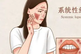 冲上热搜！红斑狼疮到底是什么病，患上有多严重？图片