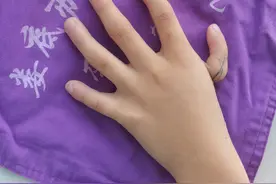 娄底市中心医院创新方法  解决男孩“漂浮拇”难题图片