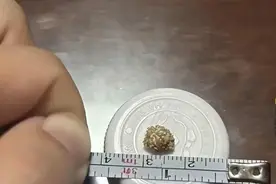 每天喝5升水排出9毫米肾结石？医生：盲目硬扛或致肾衰竭→图片