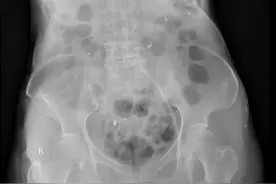 阿婆服3颗仙丹急性汞中毒图片