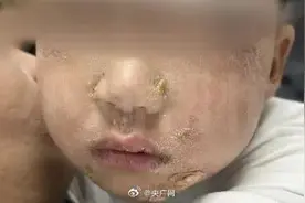 男童吃火锅烫嘴3天后全身溃烂图片