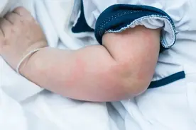 又红又痒还可能反复发作，这种烦人的病正高发！了解这些少跑医院图片