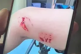 北海不明鱼类咬人！被海洋生物咬伤，第一时间应该如何处理？图片