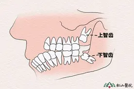 孕期智齿疼痛能不能拔？松山医院口腔专家告诉你图片