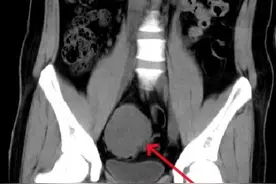 20岁小伙突发便血晕厥，医生紧急“拆除”肠道肿瘤图片