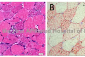 离奇！福建27岁小伙突然患“怪病”，走百步就要休息！医生却说：他太幸运了图片