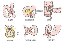 新的手术方式来啦！肠梗阻导管置入术科普→图片