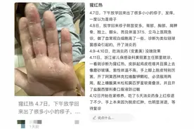 一地确诊1542例！疾控提醒：已进入高发期，传染性强！图片