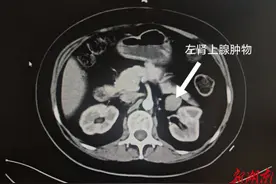 快速发胖为哪般？ 多学科联手击退“激素风暴”图片