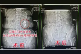 55岁女子下腹部不适，就医查出“玫瑰花状”肾结石图片
