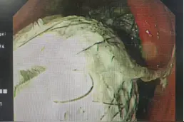 7岁女孩爱吃头发，医生从她胃里取出巨大发团……图片