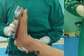 患儿双侧先天性平足症，医生在其脚背外侧开“两个小洞”矫正图片