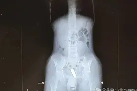 小伙竟将这东西塞进……医生紧急提醒！图片