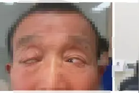 老伯高度近视眼球竟然“掉进”眼角，上海专家妙手“找回”图片