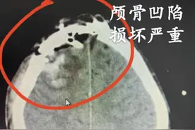13岁男生暑假骑车发生意外，医生提醒图片