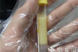 男子狂吃小龙虾喝啤酒 不料抽出“牛奶血”图片