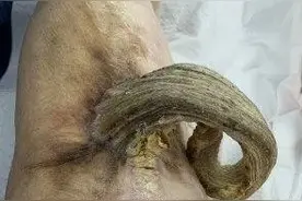 罕见！八旬老人腿上长出一只25公分长的“犄角”，原来是这种病图片